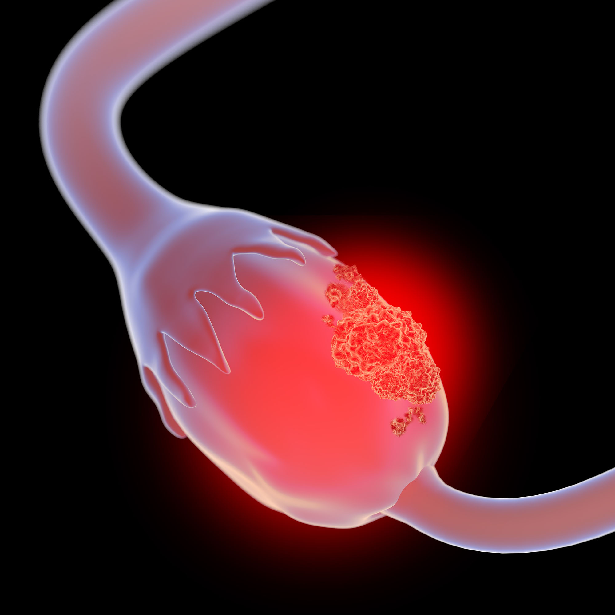 3d illustration of ovarian cancer